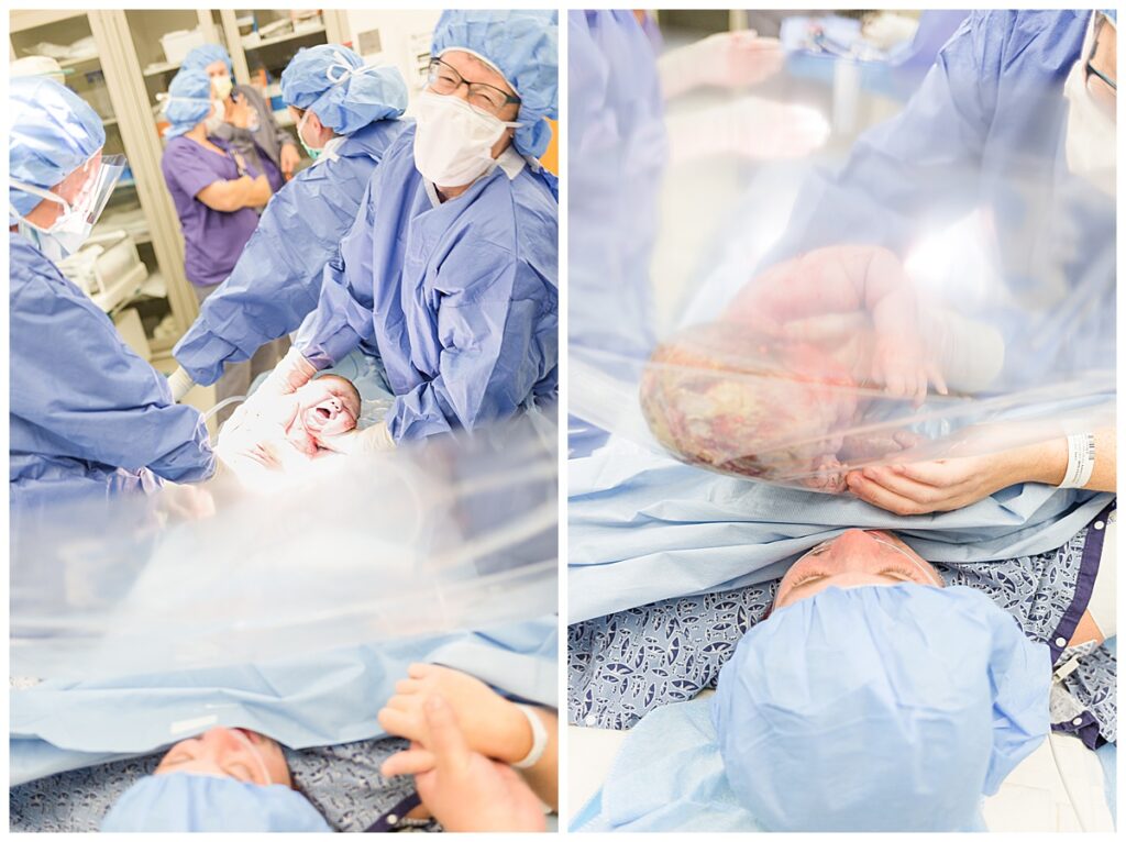 A mom experiences the birth of her baby via c-section.